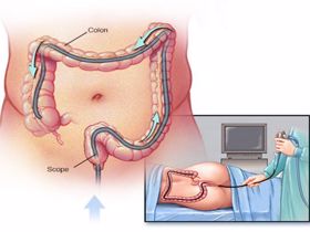 Nội soi đại tràng giá bao nhiêu? Có đau không?